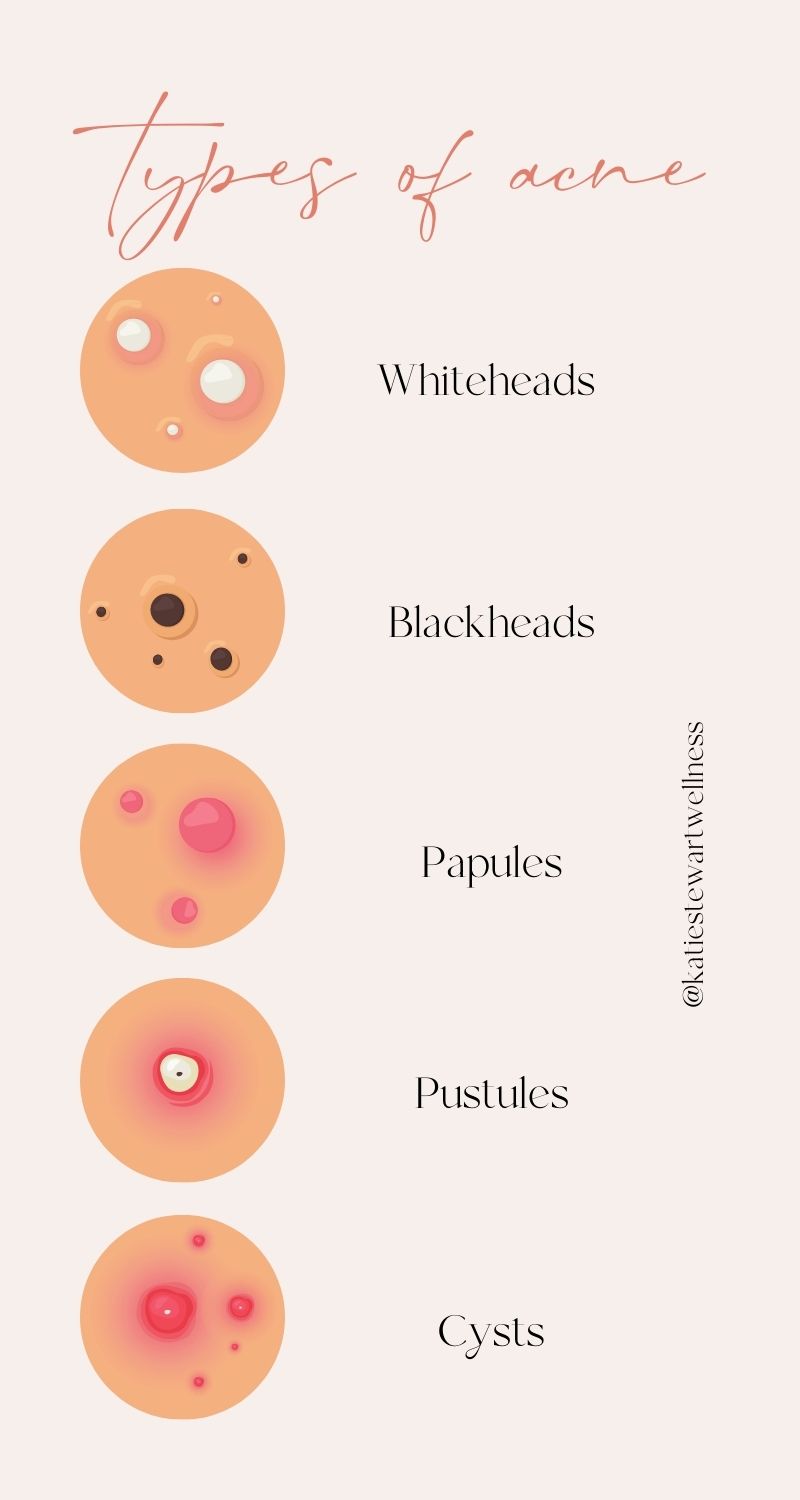 Types of acne shown in a column.