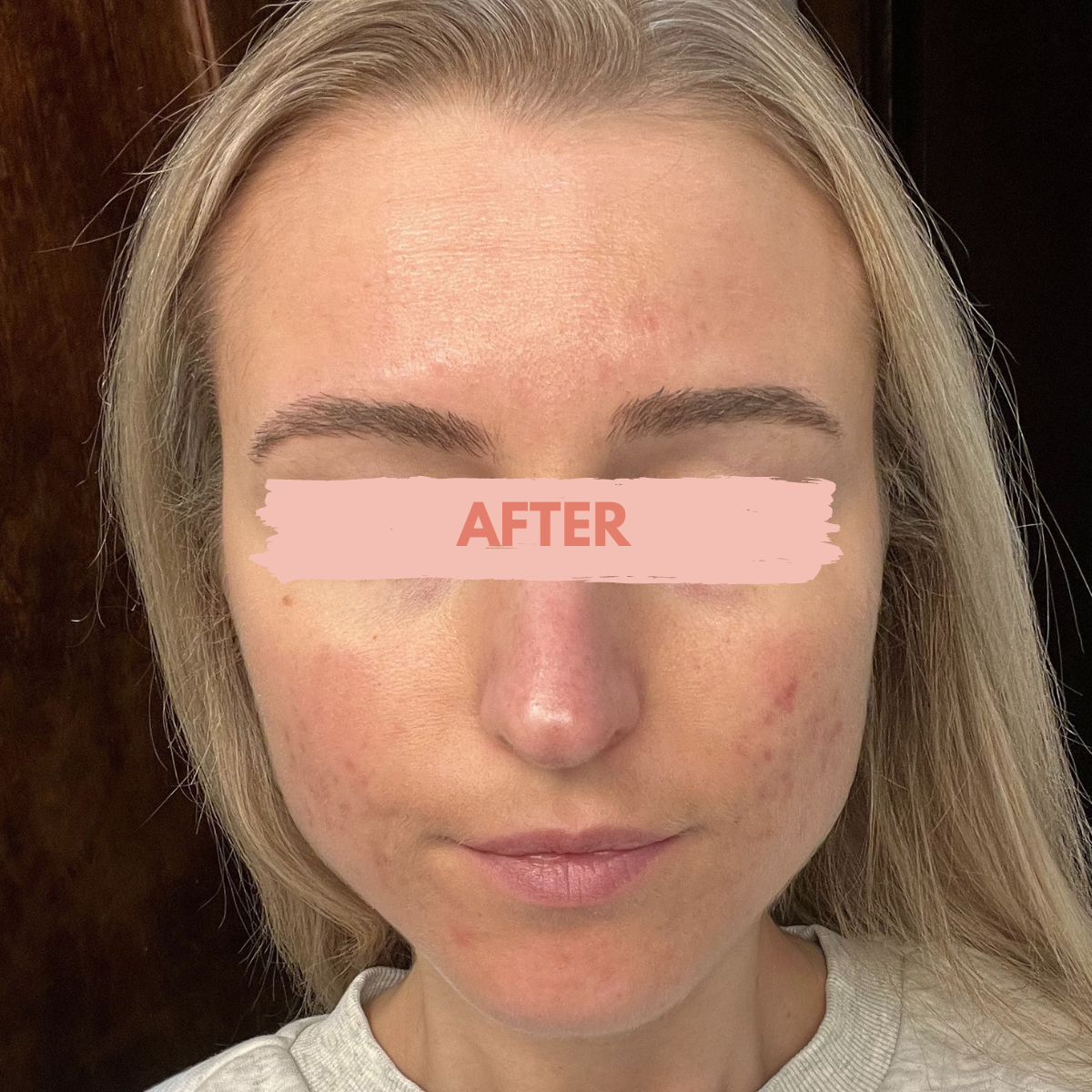 Acne-Free Without The Pill | Katie Stewart Wellness Reviews