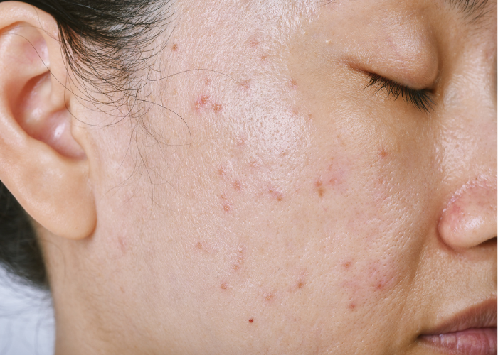 Acne impacts mental health in young woman with acne.