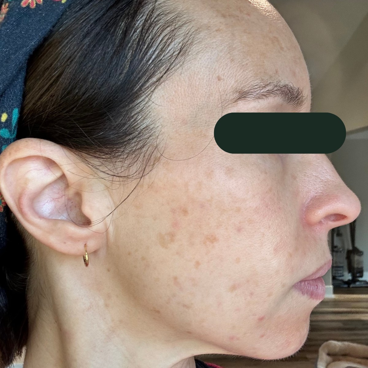 Andria, right-profile before and after, eyes redacted for privacy