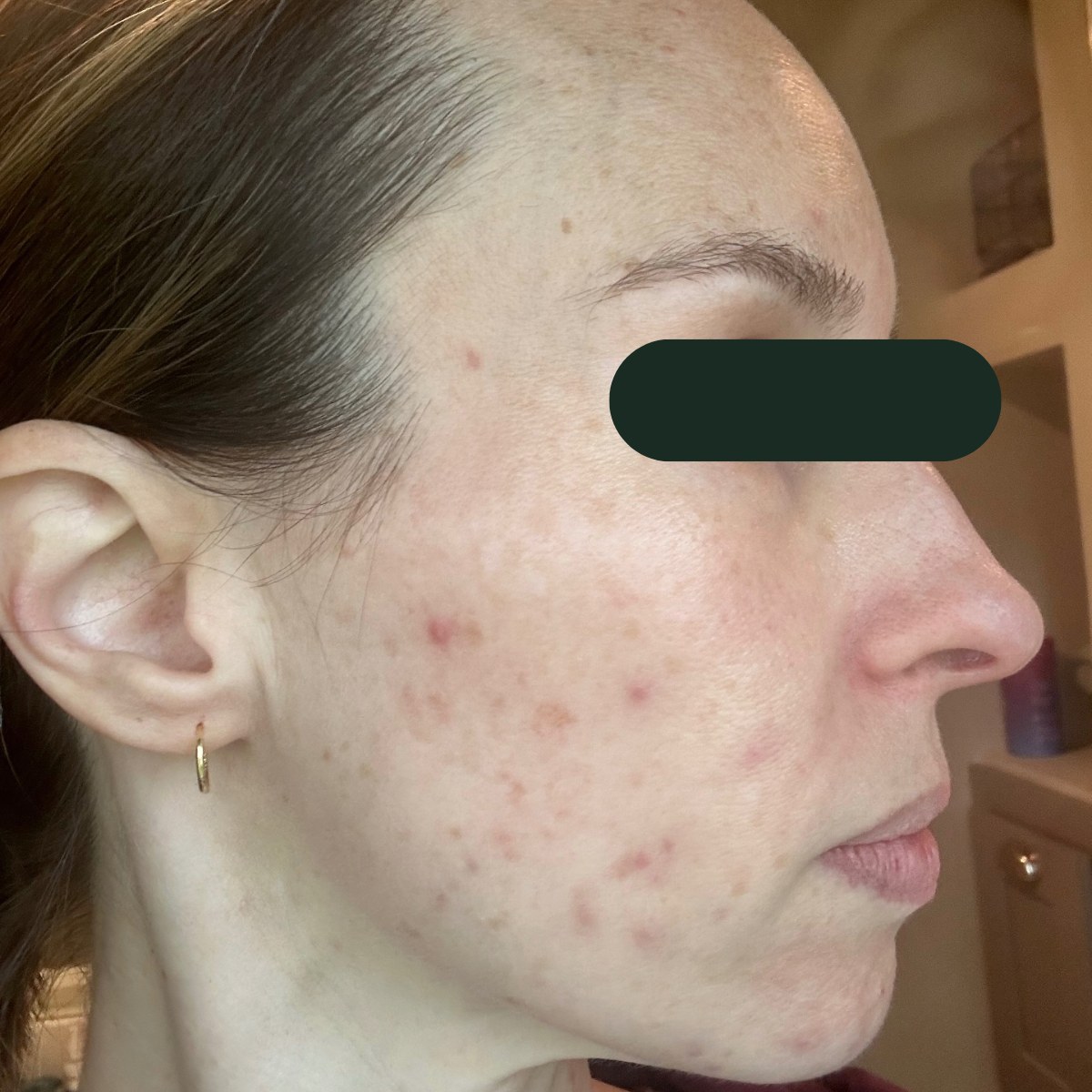 Andria, right-profile before and after, eyes redacted for privacy