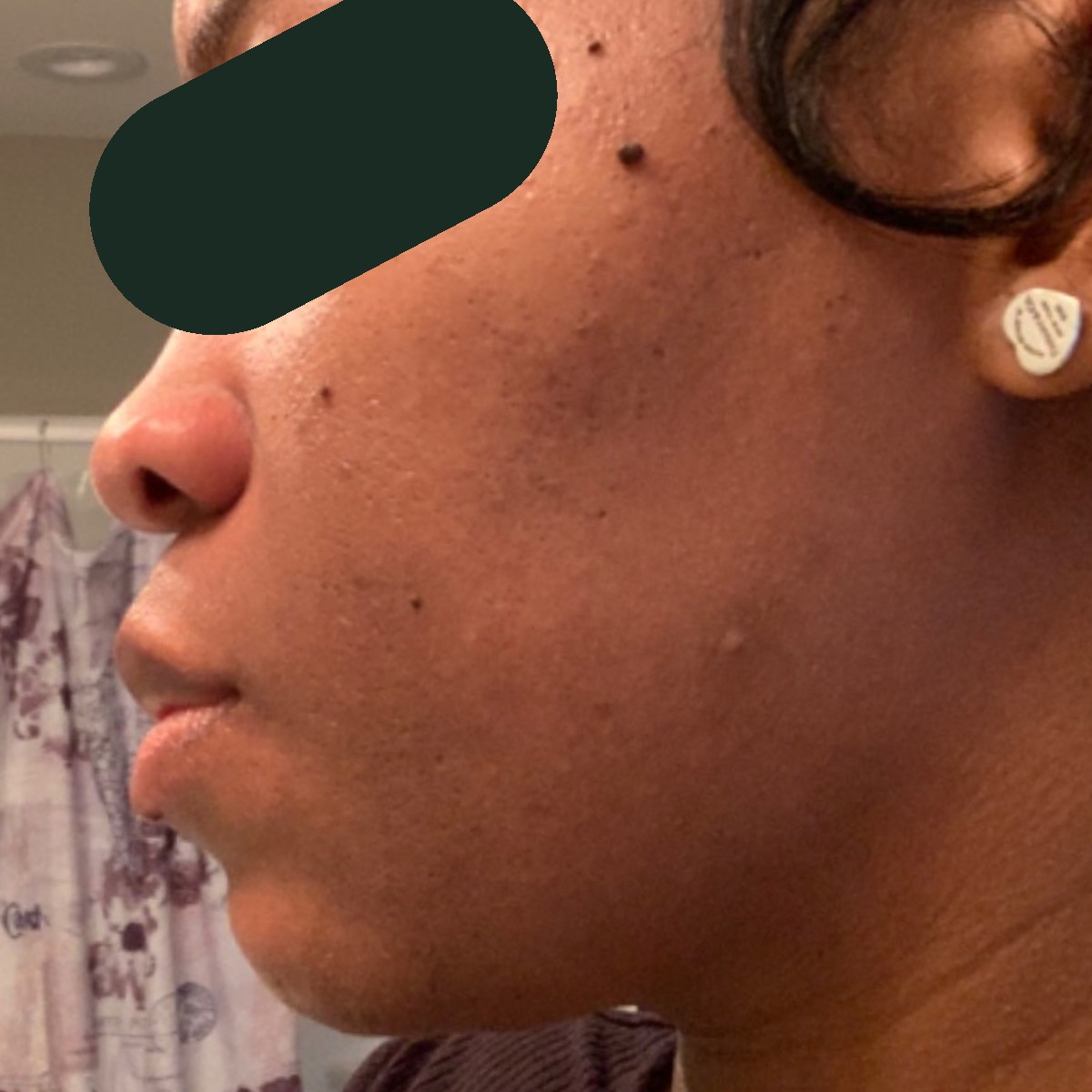 Crystal, left-profile before and after, eyes redacted for privacy