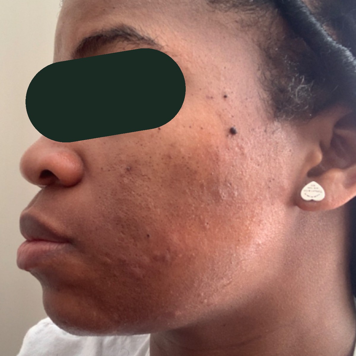 Crystal, left-profile before and after, eyes redacted for privacy