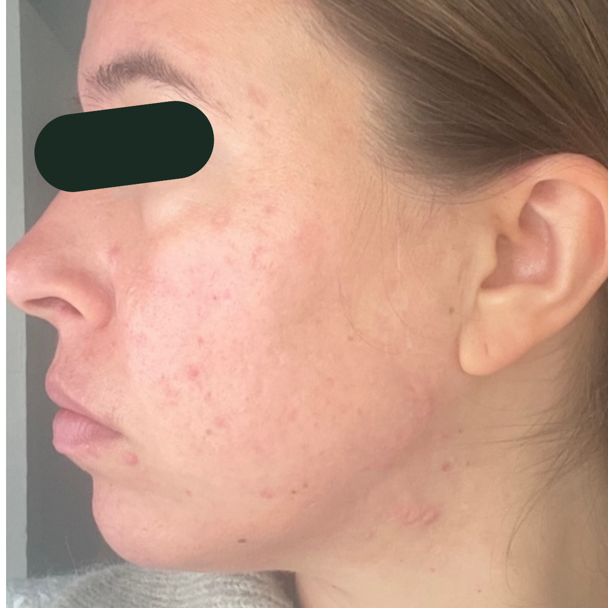 Fayth, left-profile before and after, eyes redacted for privacy