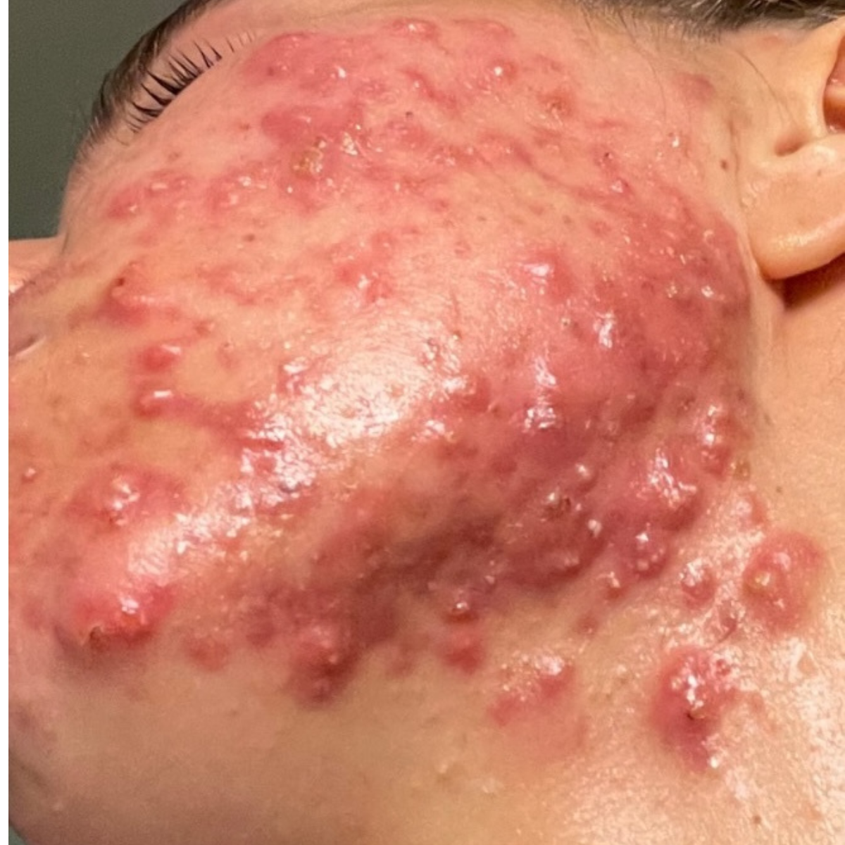 Fayth, left-profile before and after, eyes redacted for privacy
