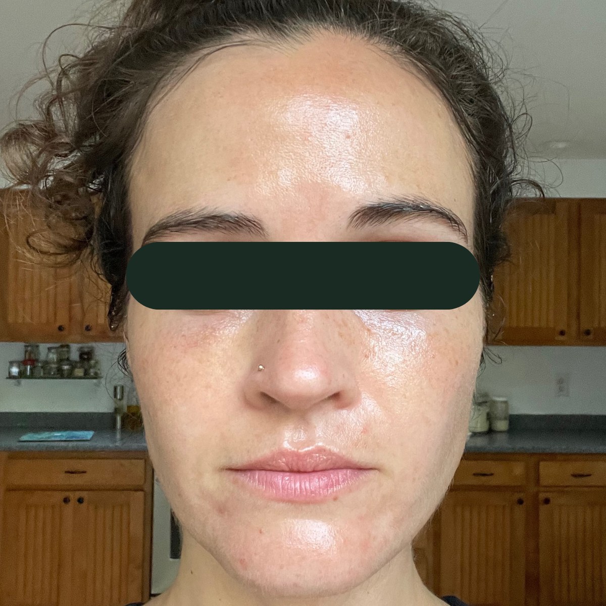 Mia, front-facing before and after, eyes redacted for privacy