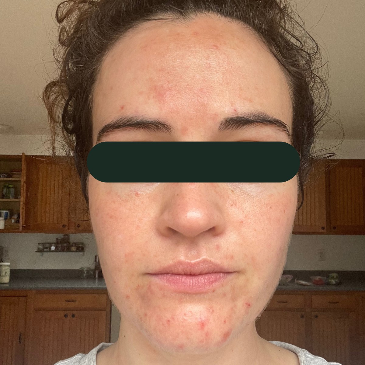 Mia, front-facing before and after, eyes redacted for privacy