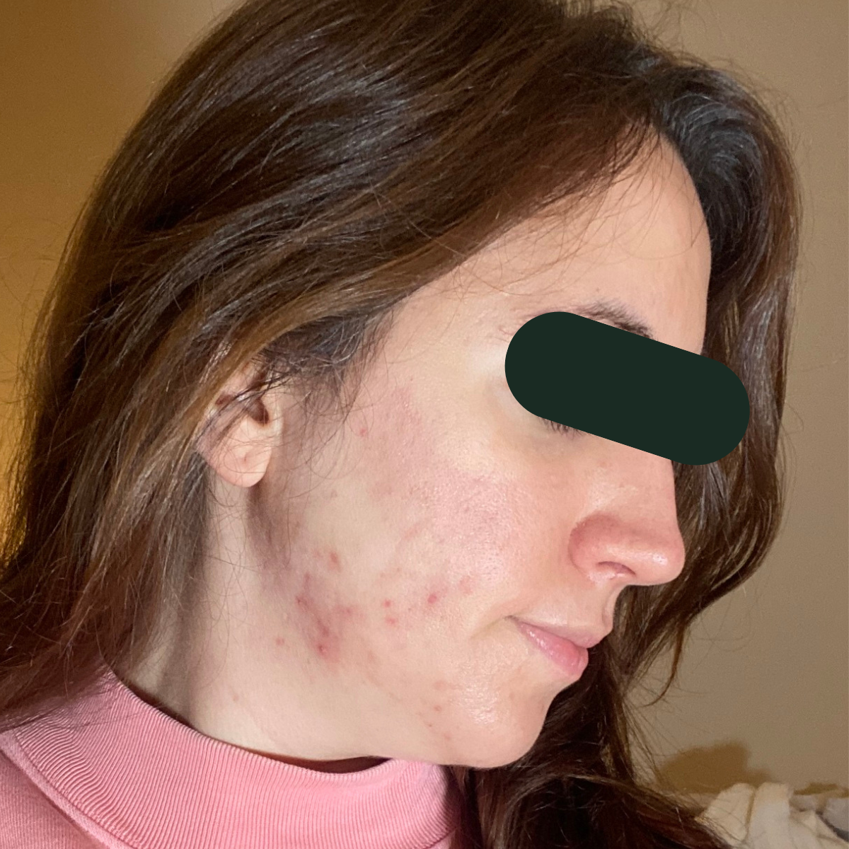Samantha, right-profile before and after, eyes redacted for privacy