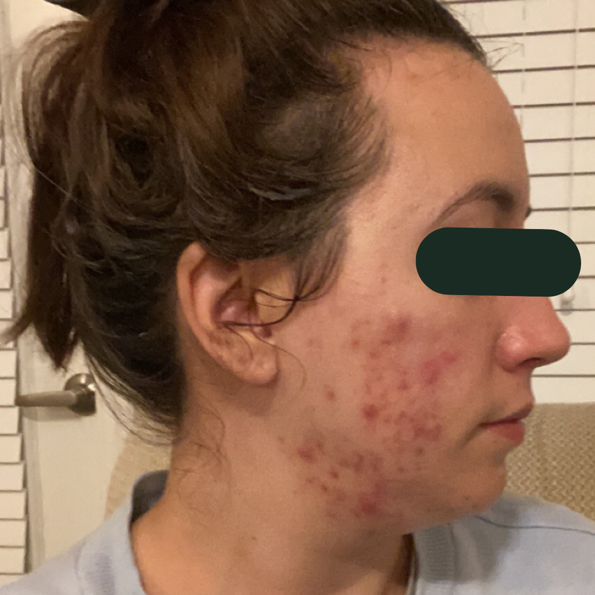 Samantha, right-profile before and after, eyes redacted for privacy