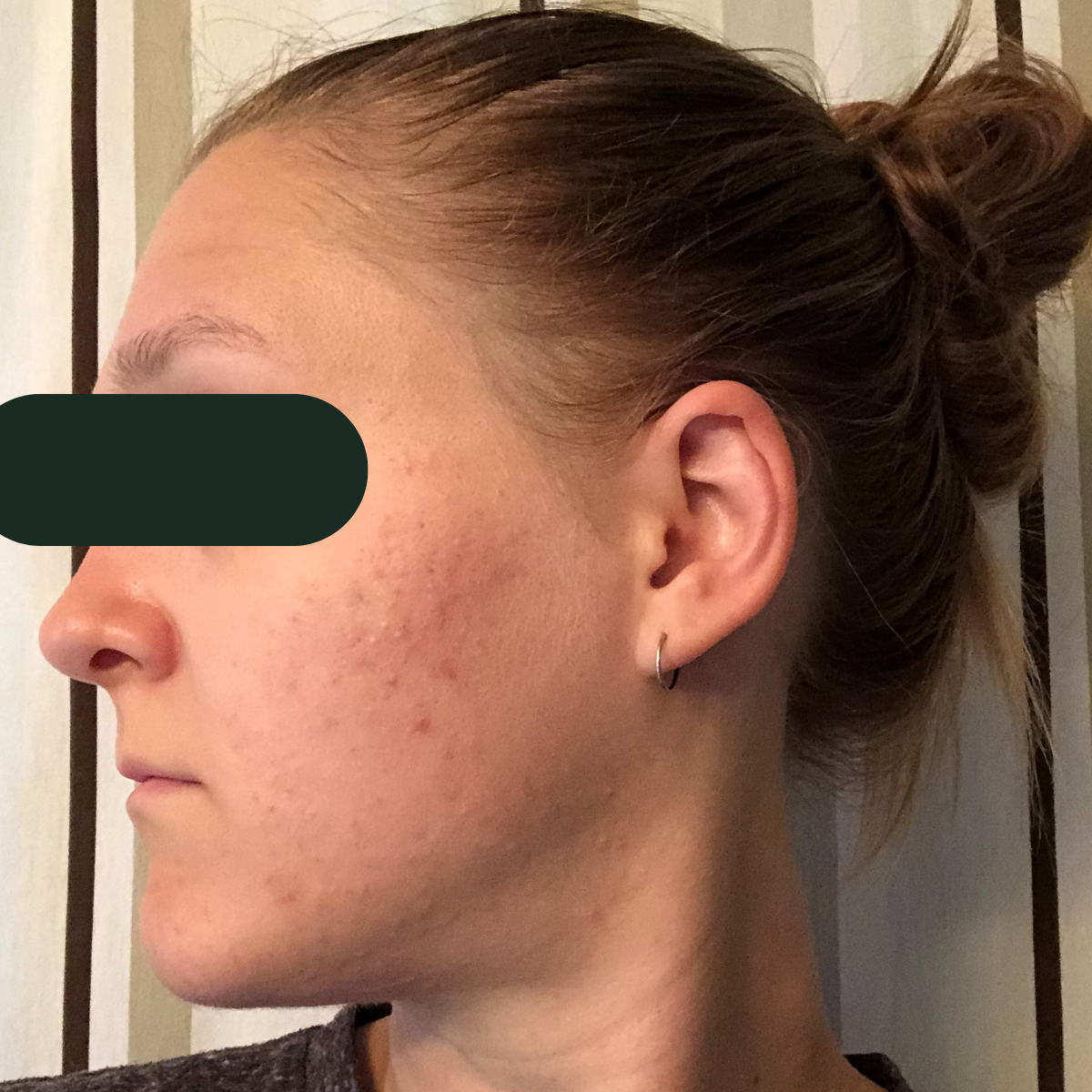Rachel E. after six months of root-cause work: calm, clear skin with even tone.