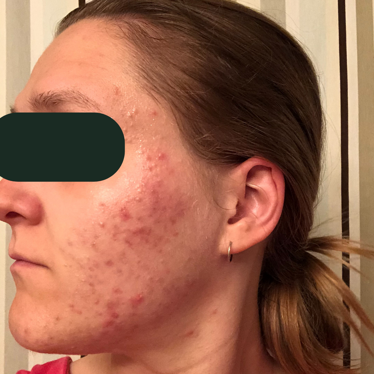 Rachel E. before working with Katie Stewart Wellness: inflamed cystic acne along jawline and cheek.