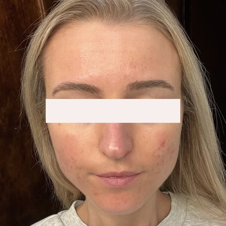 Samantha K. after her documented KSW skin journey