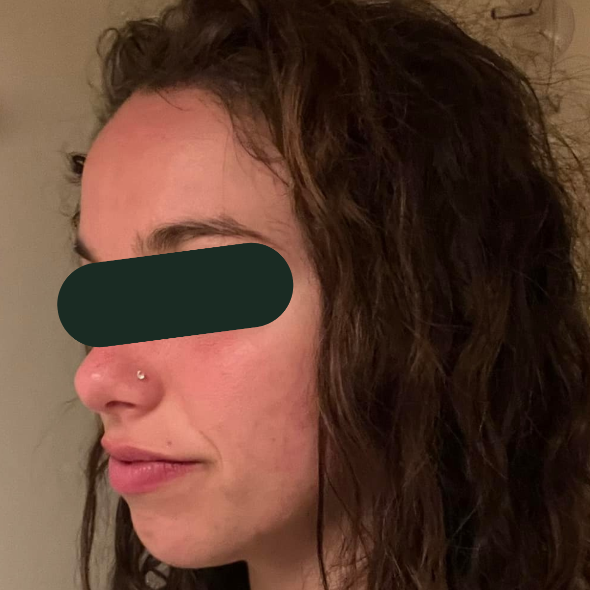 After photo of Amanda, The Clear Skin Solution client 1