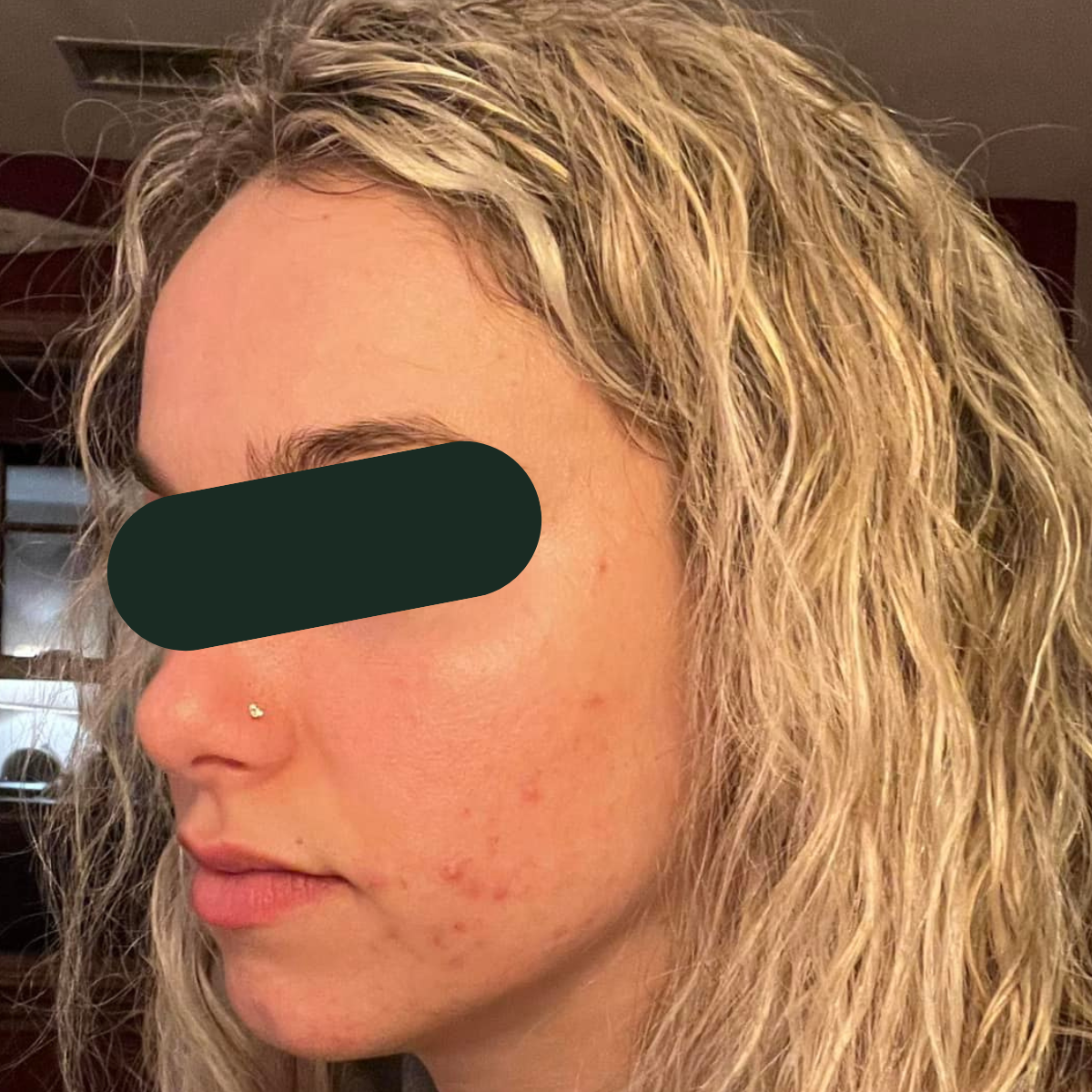Before photo of Amanda, The Clear Skin Solution client 1