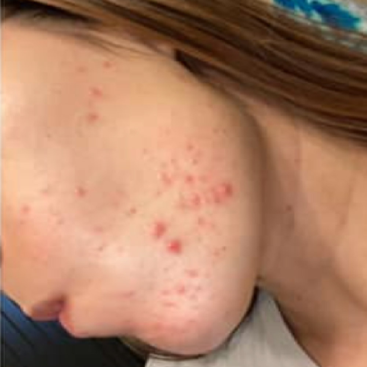 Before photo of Angela, The Clear Skin Solution client 5