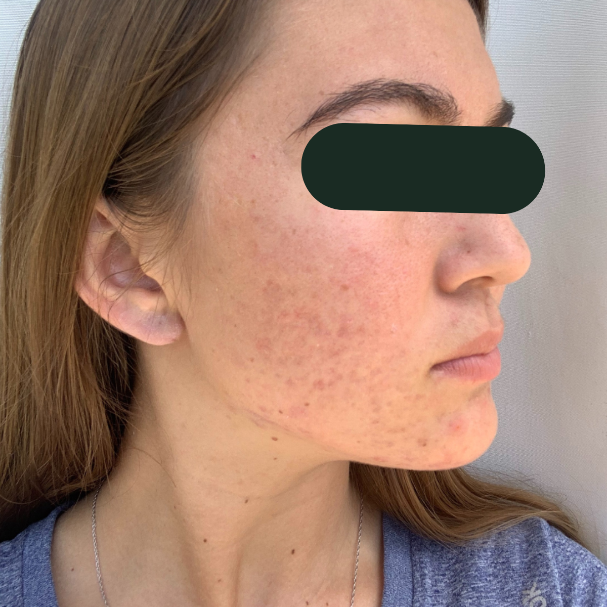 After photo of Ariana, The Clear Skin Solution client 8