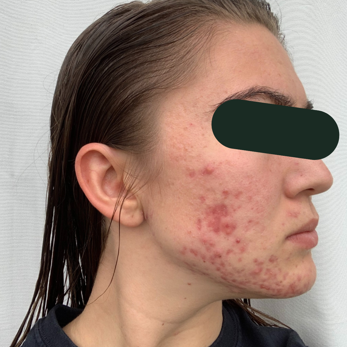 Before photo of Ariana, The Clear Skin Solution client 8