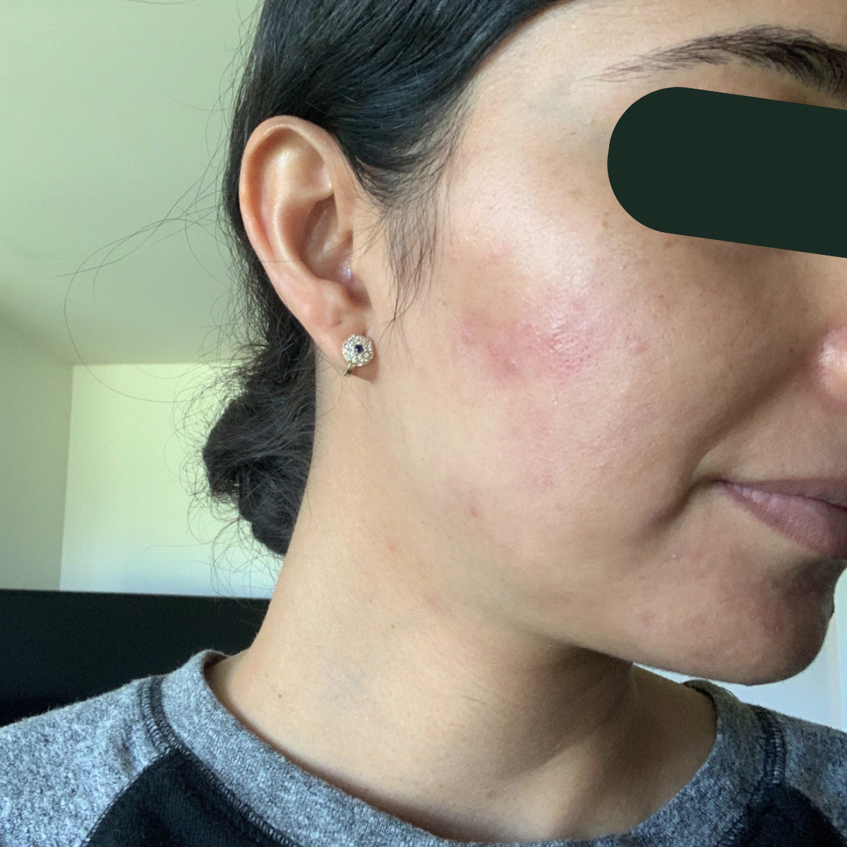 After photo of Aya, The Clear Skin Solution client 6