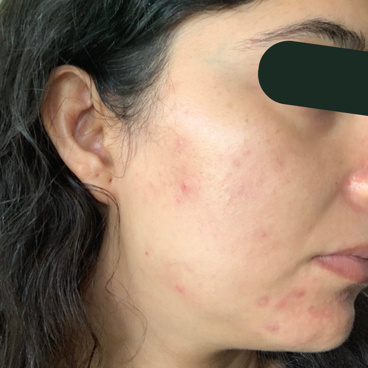 Before photo of Aya, The Clear Skin Solution client 6