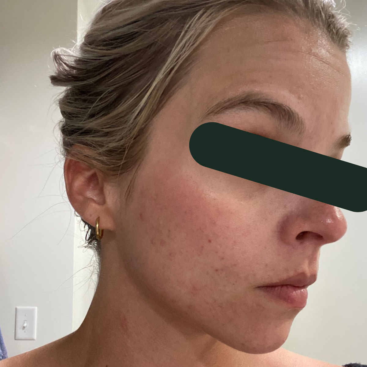 After photo of Emily, The Clear Skin Solution client 2