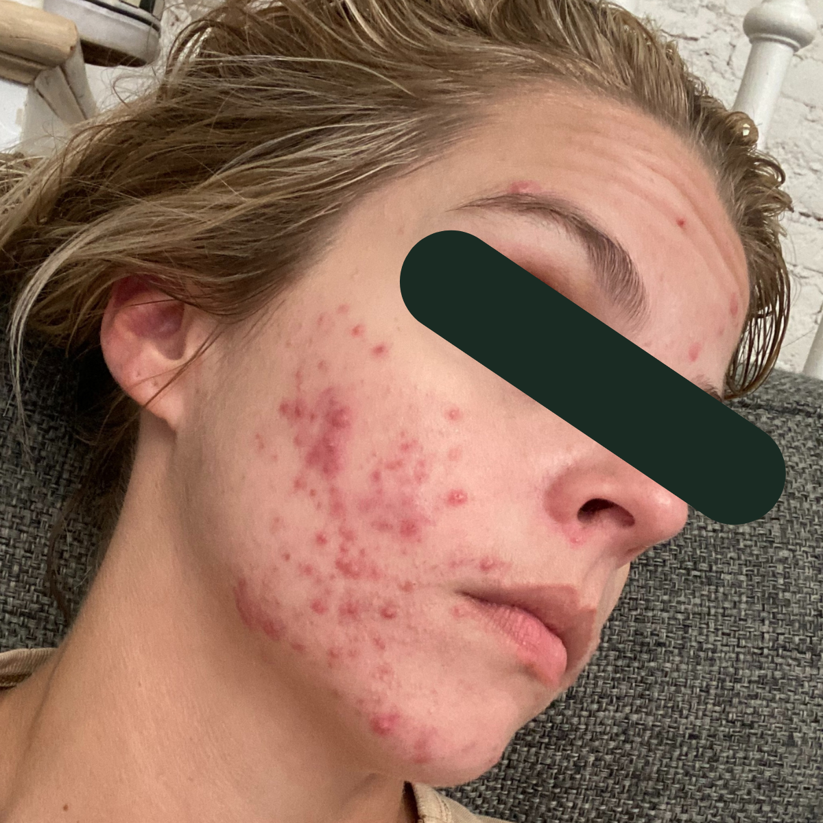 Before photo of Emily, The Clear Skin Solution client 2