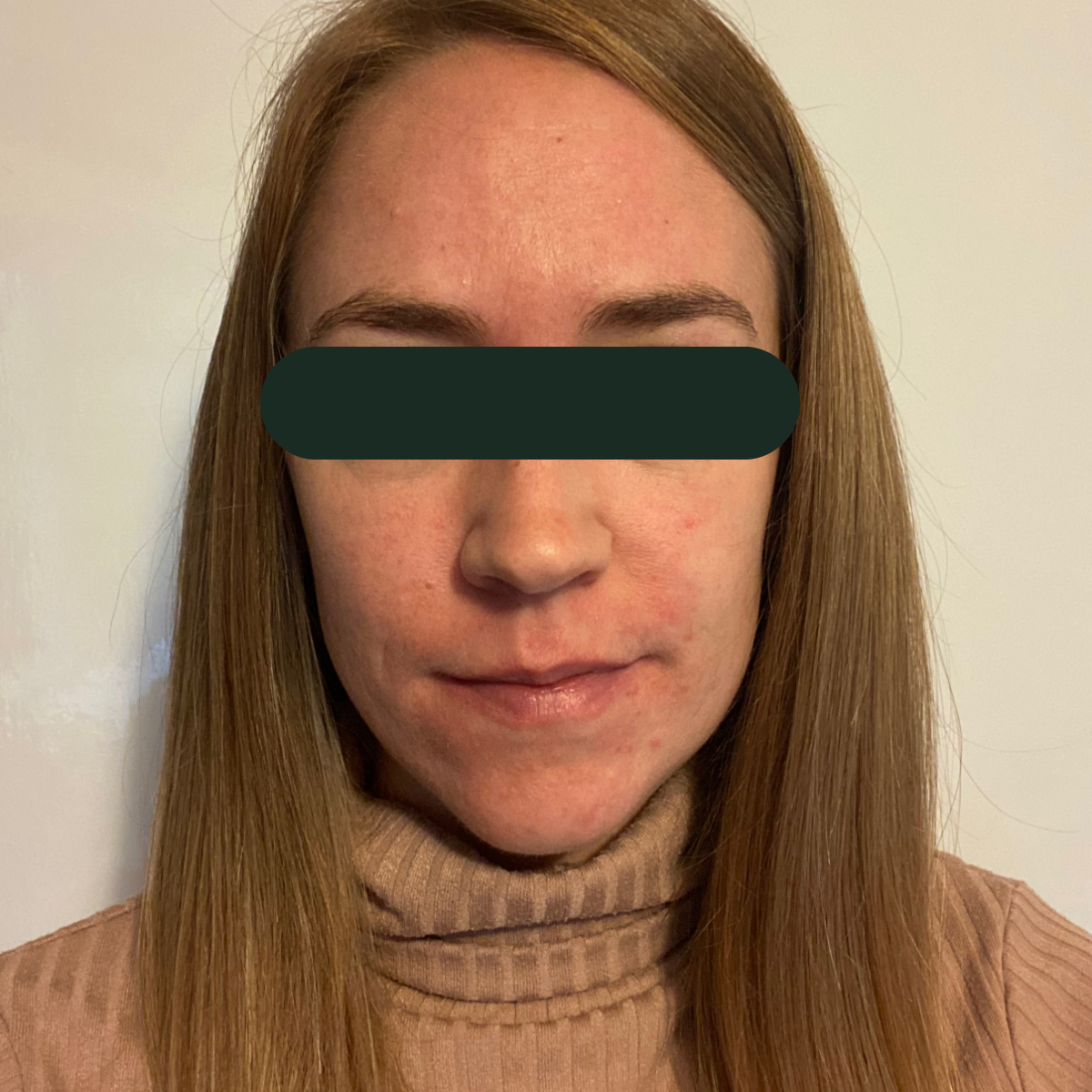 After photo of Emily, The Clear Skin Solution client 7