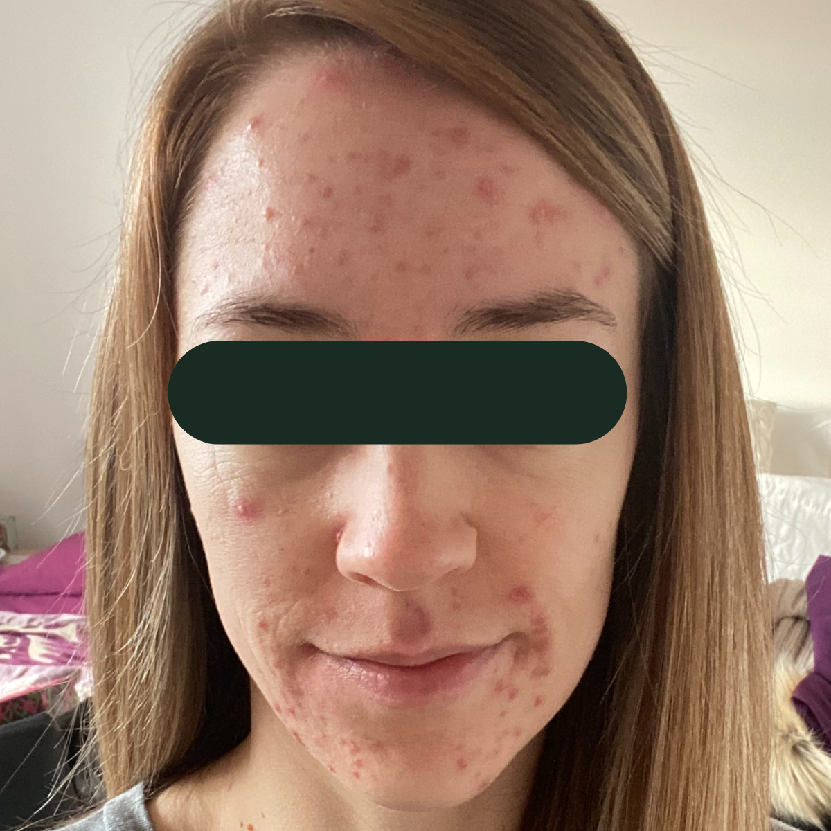 Before photo of Emily, The Clear Skin Solution client 7