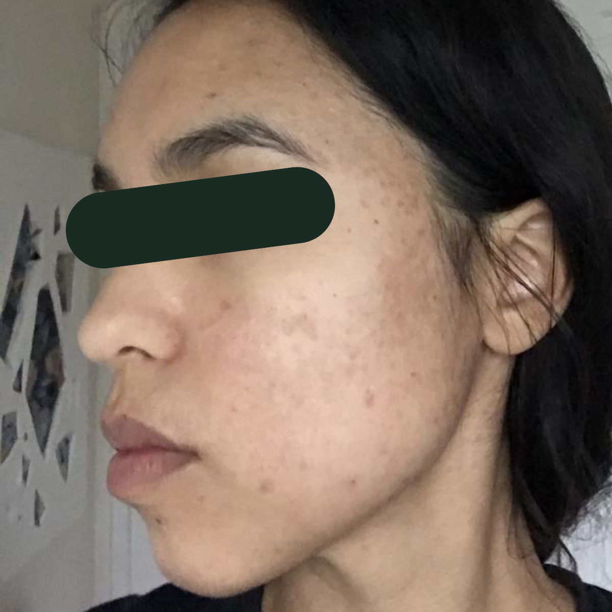 After photo of Faith, The Clear Skin Solution client 3