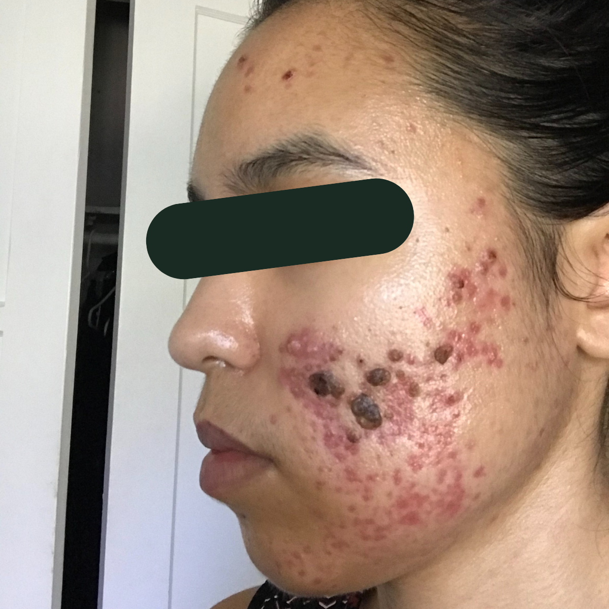 Before photo of Faith, The Clear Skin Solution client 3
