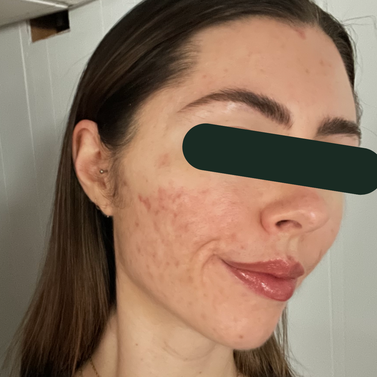 After photo of Lizzie, The Clear Skin Solution client 4