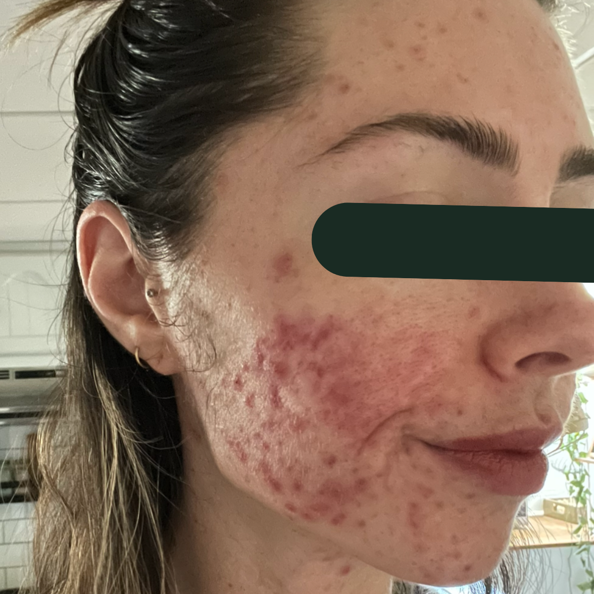 Before photo of Lizzie, The Clear Skin Solution client 4