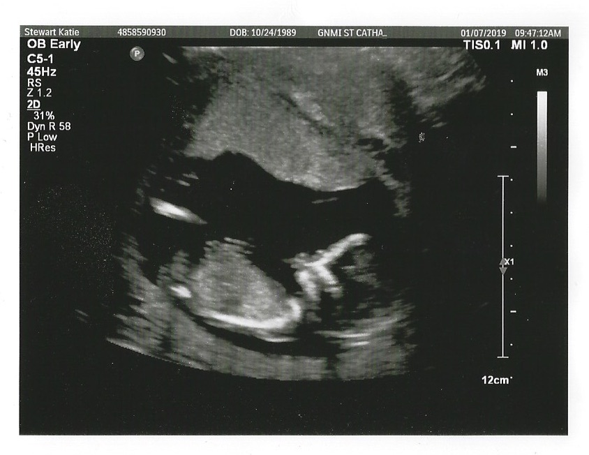 13-week ultrasound taken five weeks before miscarriage.